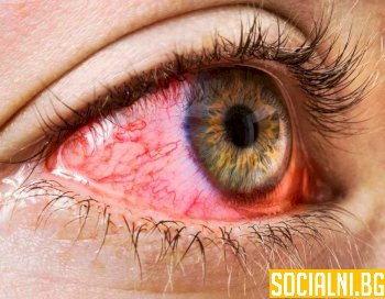 Конюктивитът: едно от най-често срещаните възпаления на очите
